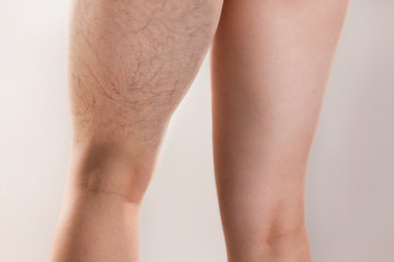 Medicine and varicose veins. Sports women's legs with varicose veins on the thigh, close-up. White background