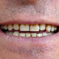 Obraz premium neglected mouth and yellowed teeth of a person,