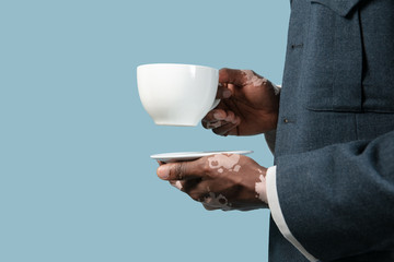 Close up of male hands with vitiligo pigments isolated on blue studio background. Wearing office attire, workwear. Special skin. Holding cup. Business, finance, advertising concept. Copyspace.