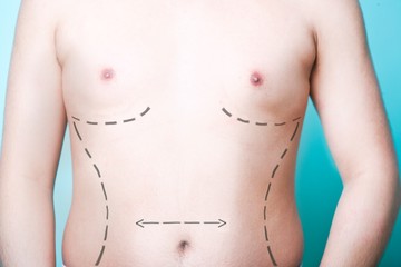 Close-up view of man's body with plastic surgery line markings