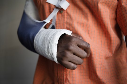 Man With Broken Arm In Cast