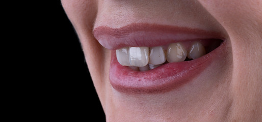 Obraz premium planning and making press ceramic veneers