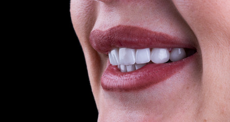 planning and making press ceramic veneers