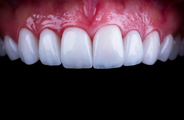 planning and making press ceramic veneers