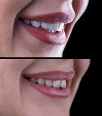 planning and making press ceramic veneers