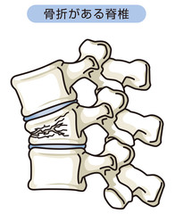骨折がある脊椎　圧迫骨折