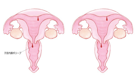 子宮頸管（内膜）ポリープ