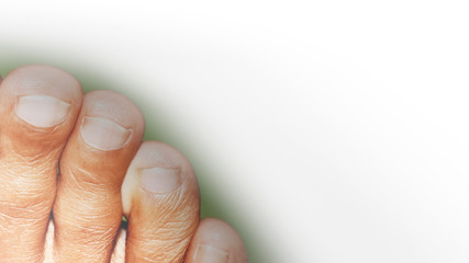 Unnatural crooked toe on a blurred white background