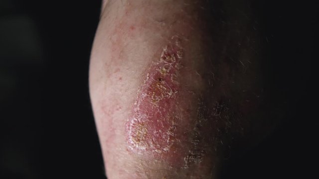 Dry scab on elbow. Partially healed. Scrape and bruise. Healing. 4k.