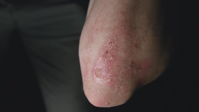 Healing scab on male elbow. One week recovery from open graze wound. 4k