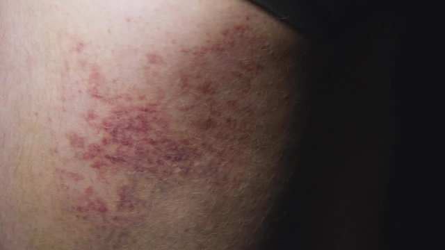 Large colourful bruise on leg. Painful wound recovery. 4k