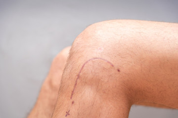 neat postoperative suture on the knee, leg on a light background