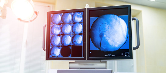 surgery monitor at clinic while operating process. Special technic. Advanced modern technologies. Hospital. Closeup.