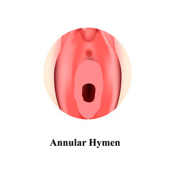 The structure of the vulva hymen annular. Hymen after defloration. Female genital organs. Infographics. Vector illustration on isolated background.