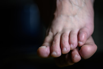 Close up of shamed woman hiding her altlete's foot fungus infection