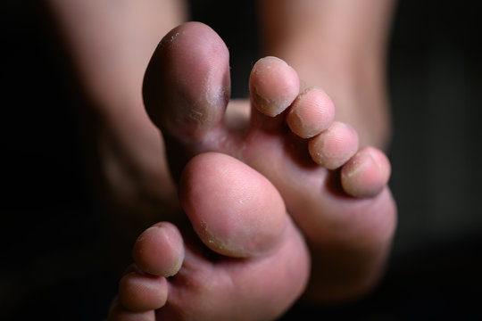 Close up of woman feet having tinea pedis althlete's fungus infection