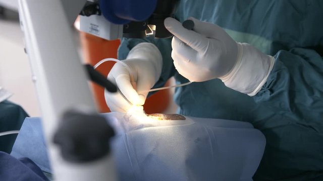 Surgeon using little pump to insert fluid into eye during eye surgery