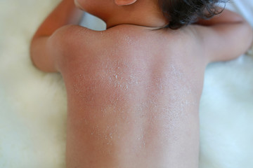 Close up baby back dry skin. Baby have very dry peeling skin.