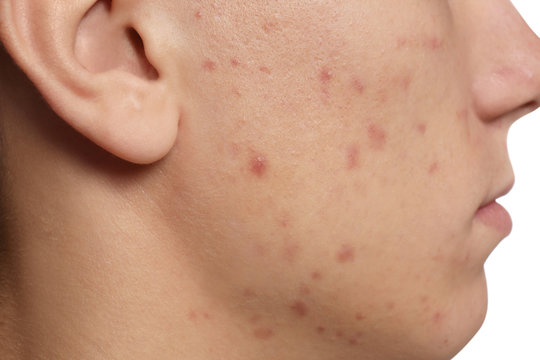 Teen guy with acne problem on white background, closeup