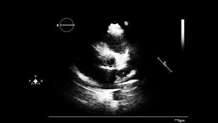 Image of the heart in gray-scale mode during transesophageal ultrasound.