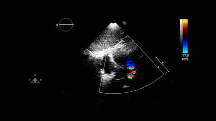 Image of the heart during transesophageal ultrasound with Doppler mode.