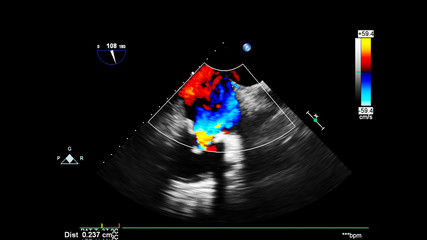 Image of the heart during transesophageal ultrasound with Doppler mode.
