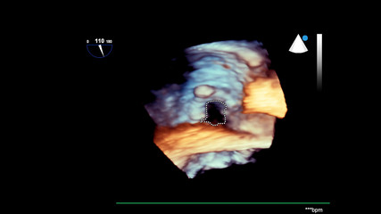 3D image of the heart during transesophageal ultrasound of the heart.