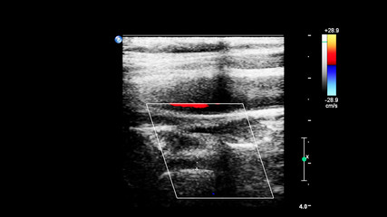 Pulse Wave Doppler Ultrasound Examination.