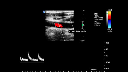 Pulse Wave Doppler Ultrasound Examination.