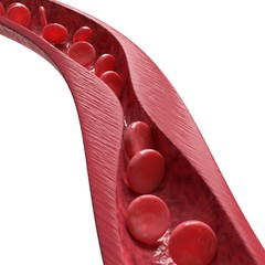 Atherosclerosis closeup. 3d illustration isolated on white