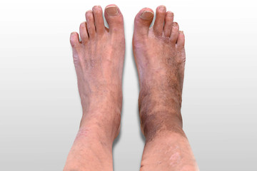 Рhlebeurysm lower limbs