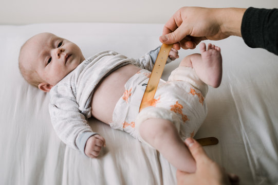 Baby with Hip Dysplasia