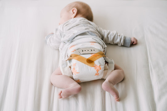 Baby with Hip Dysplasia