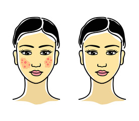Acne on the face of a young girl. Vector illustration. 