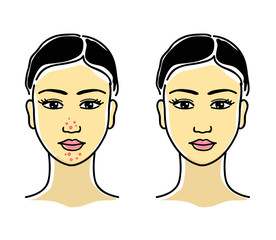 Acne on the face of a young girl. Portrait. Vector illustration.