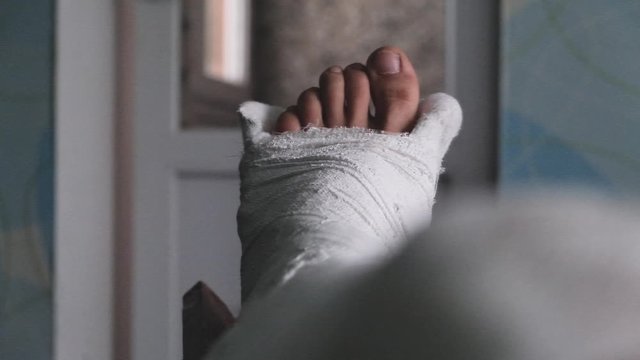 Young man with broken plaster leg trying to move toes