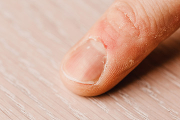 Finger condition before manicure - crooked dirty nails