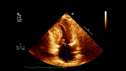 Image of the heart in gray-scale mode during transesophageal ultrasound.