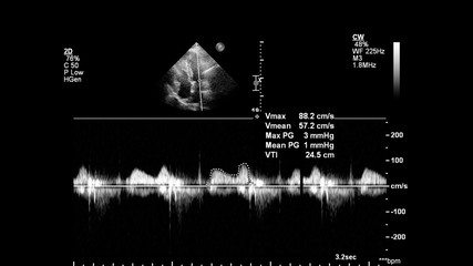 Image of the heart in gray-scale mode during transesophageal ultrasound.