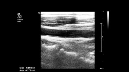 Ultrasound examination of blood vessels in grayscale mode.
