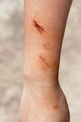 The wound form scabs on hand and arm. The wound happen during woman Injuries from falling down on...