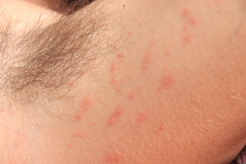 Close up of contact dermatitis rash and skin bumps in Caucasian skin as a result of an allergic reaction