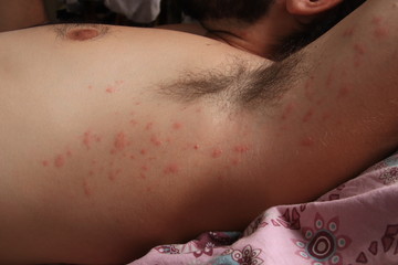 Close up of contact dermatitis rash and skin bumps in Caucasian skin as a result of an allergic...