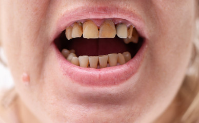bad teeth in a smoking woman
