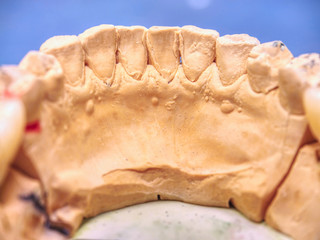 Metal-ceramic dental crown is tried on an gypsum model
