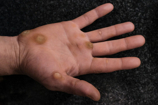 Dermatological issue,verruca warts,on worker man hand,medical healthcare concept
