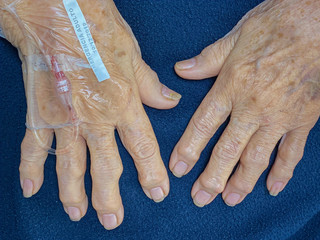 View of the hands in a mature female patient with osteoarthritis