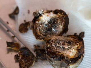 Large crystallized gallstone, cut when viewed. The concrement was extracted during laparoscopic cholecystectomy, surgery to remove the gallbladder. Complications of gallstone disease.