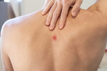 Big red pimple on a man back, close up of an abscess