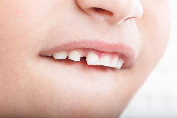 Fototapeta premium Baby tooth, close-up of the tooth that falls macro shot